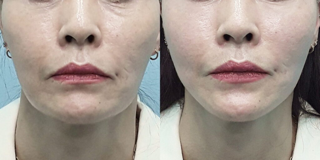 BIOFACE 糸リフト 症例写真