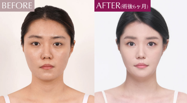輪郭整形症例