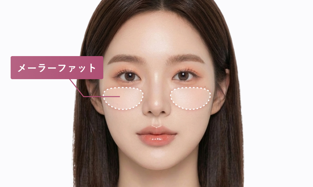 メーラファット：頬の中央から上の脂肪を指す