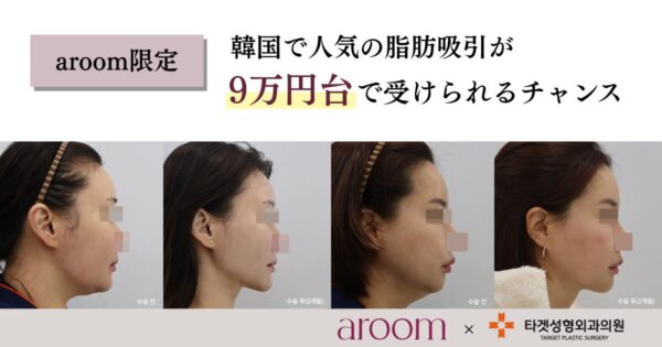 韓国人気クリニックの脂肪吸引が今だけ9万円台のお得なキャンペーン