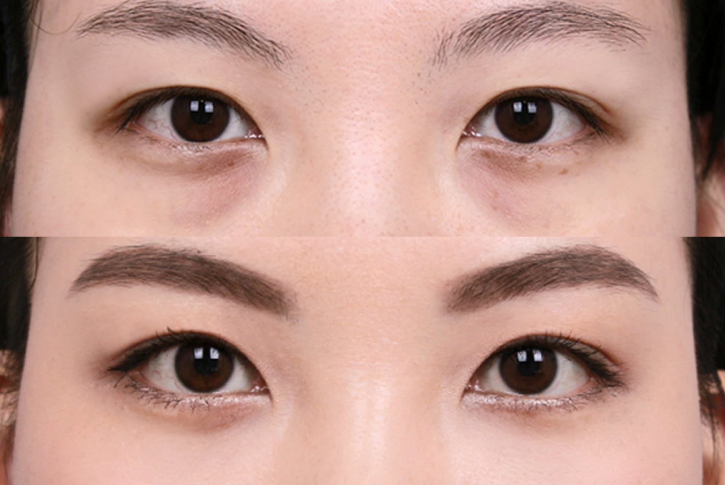 ラミチェ美容外科の症例写真(目の下脂肪再配置)