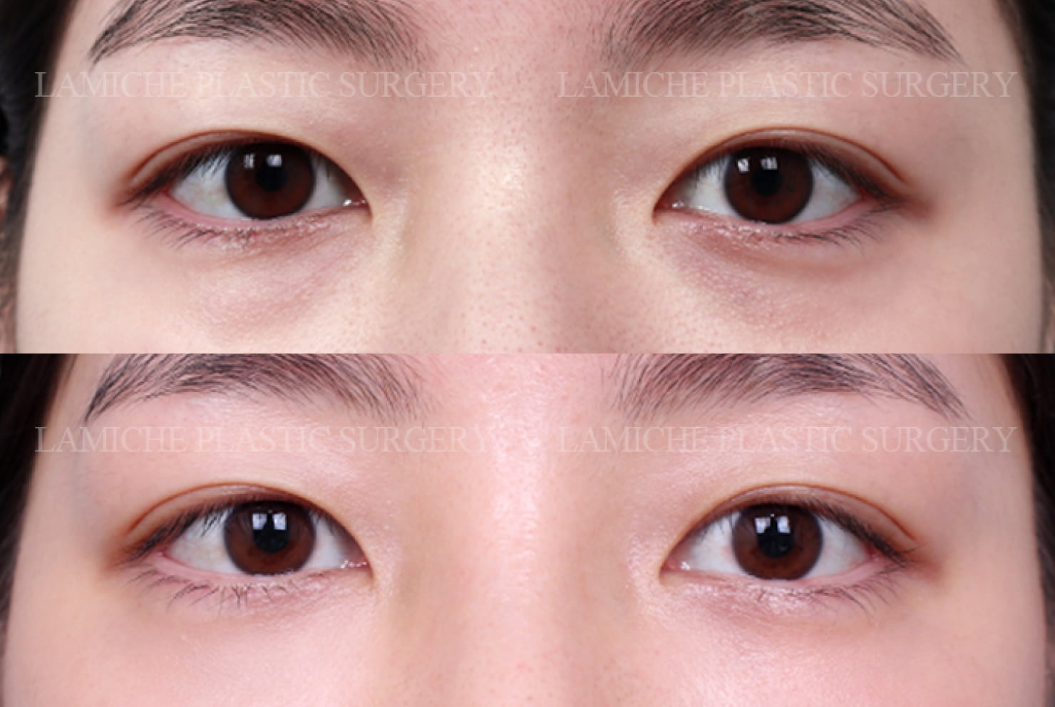 ラミチェ美容外科の症例写真(目の下脂肪再配置)