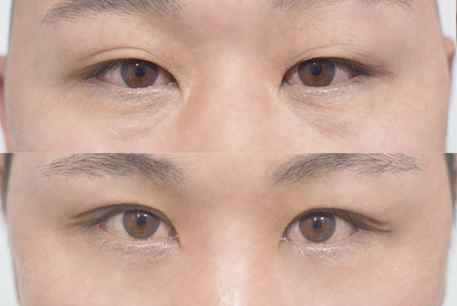 ラビアン整形外科の症例写真(目の下脂肪再配置)