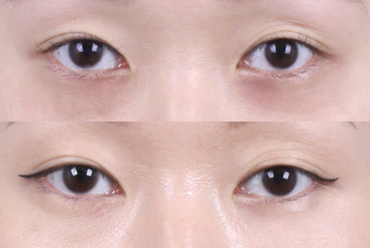 リエンジャン美容外科の症例写真(目の下脂肪再配置)