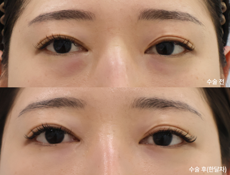 ターゲット整形外科の症例写真(目の下脂肪再配置)