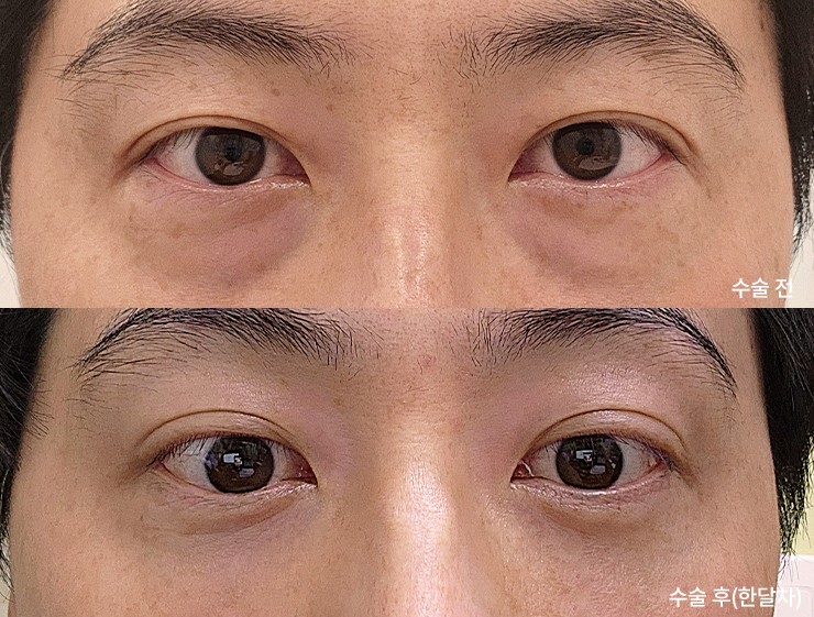 ターゲット整形外科の症例写真(目の下脂肪再配置)