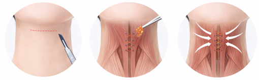 顎下筋肉縛りの手術過程
